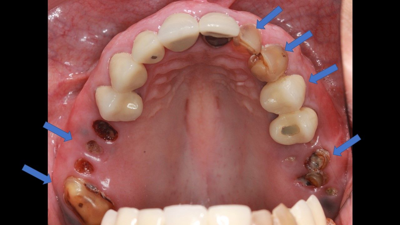 Retracted views of the patient’s oral condition 