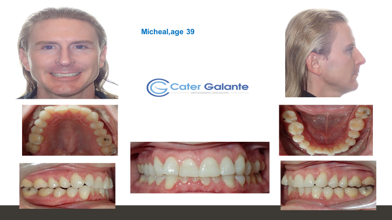 How to enhance the orthodontic experience with Propel VPro