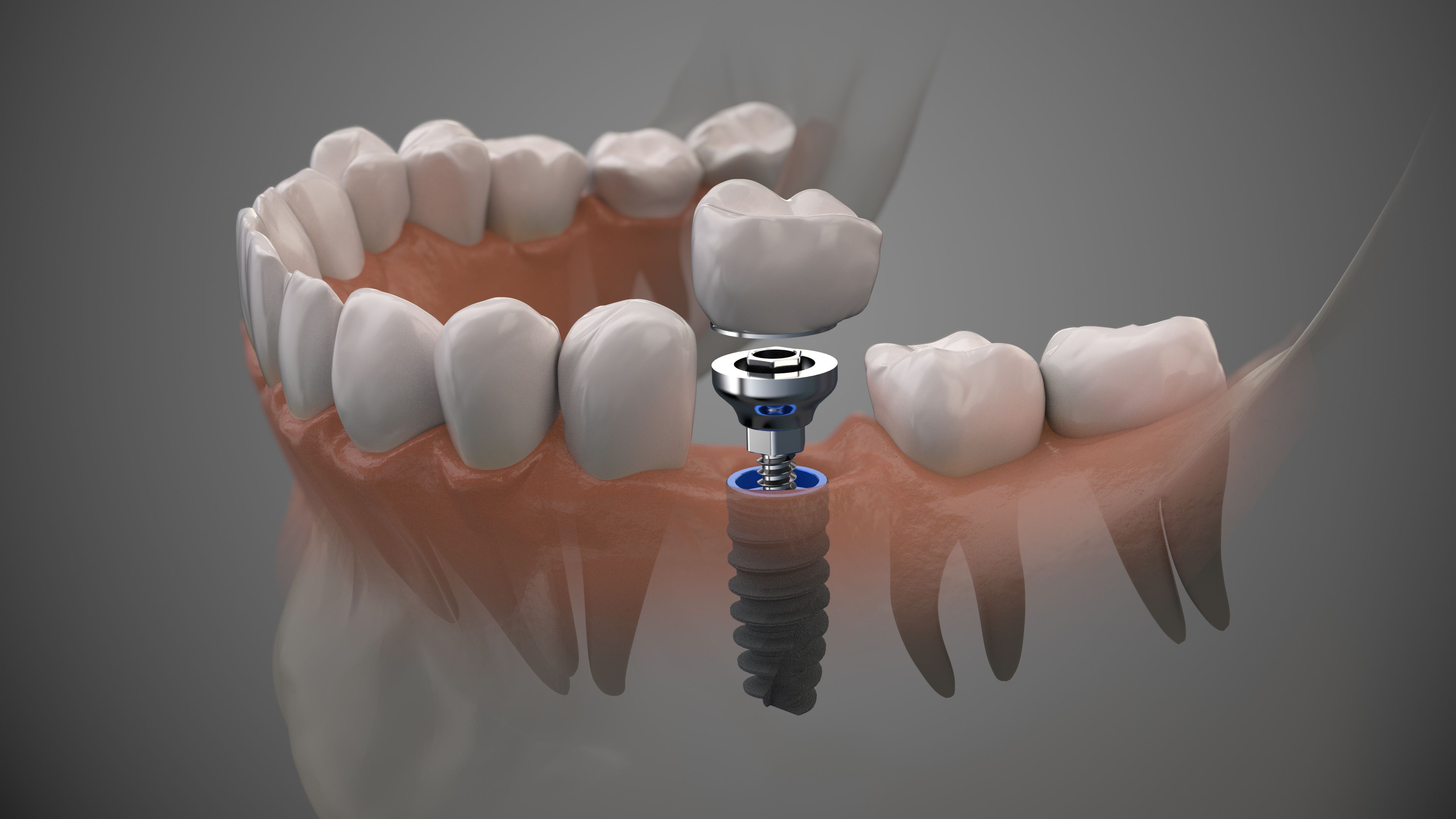 How to choose between cement-retained or screw-retained implants