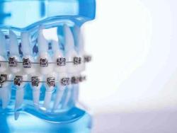KLOwen Orthodontics Unveils Custom Metal Self-Ligating Solution