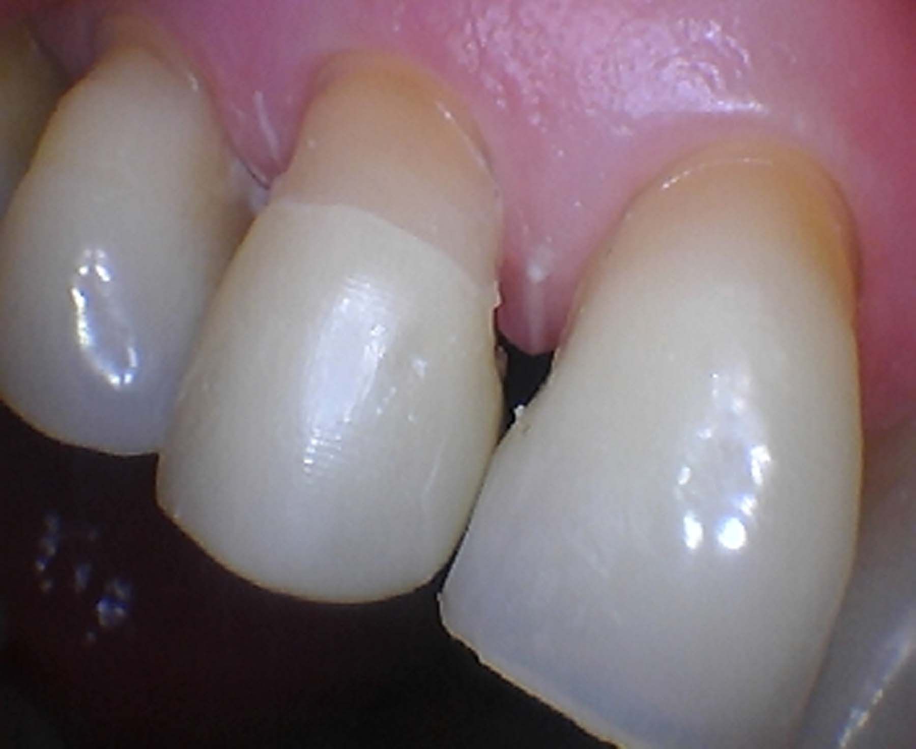 Figure 4. Excess cement was removed from all surfaces and allowed to sit. | Image Credit: © Ben Alvarez, DDS