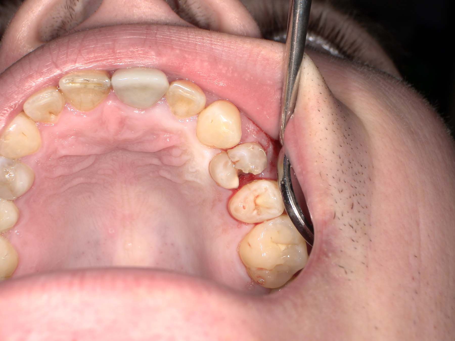 Figures 1-2.  Case 1, a 34-year-old man. Patient presented in need of extraction of #12 following a chronic apical abscess that led to a large swelling extending to the orbit. 