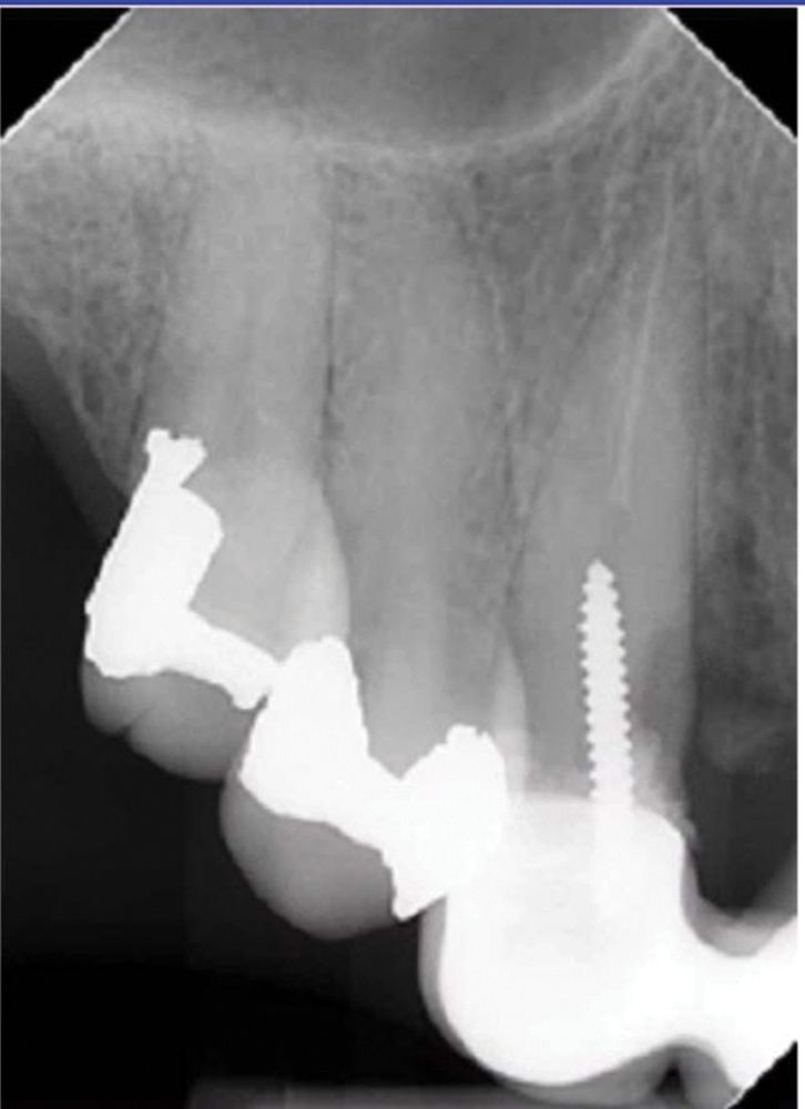 The bridge shown in Figure 1 was failing, and the patient requested an implant.