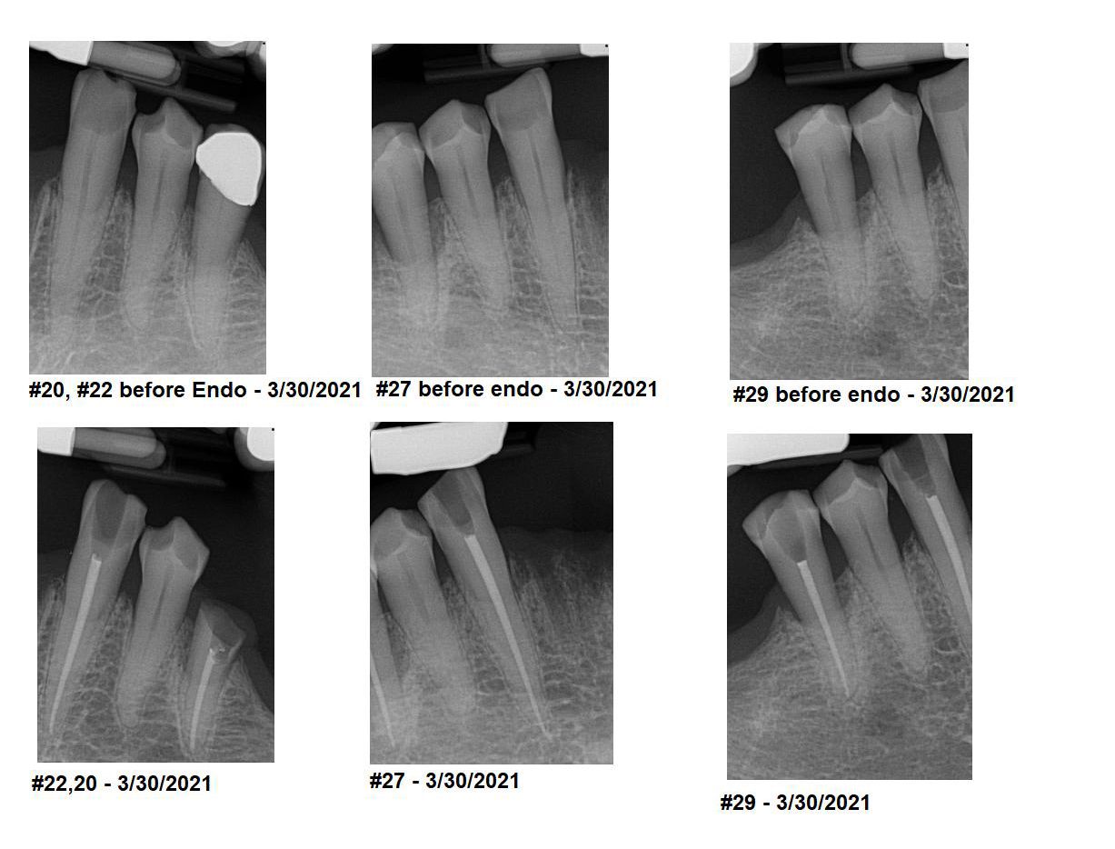 Figure 10. Pre-op and post-op radiographs of completed F-360 therapies (Komet USA).