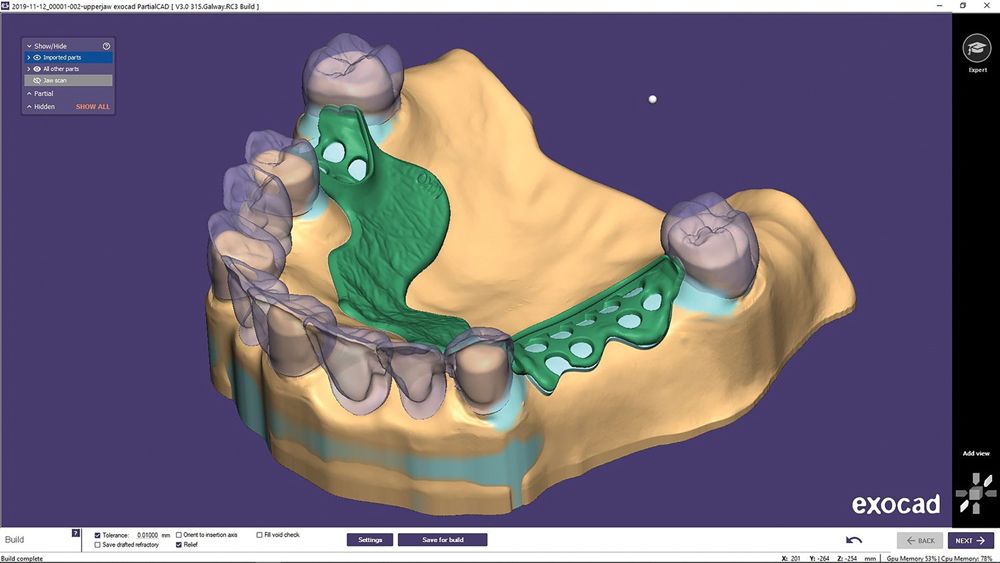 exocad’s New Module PartialCAD 3.0 Galway Includes Advanced Design Features