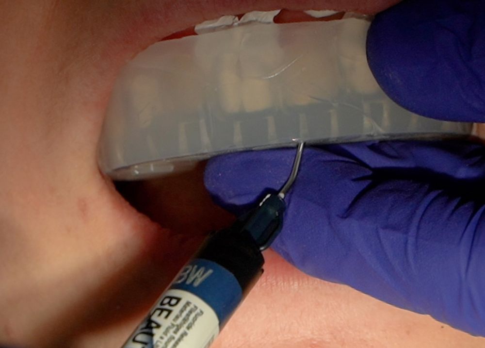 How To Develop an Injection Bonding Solution