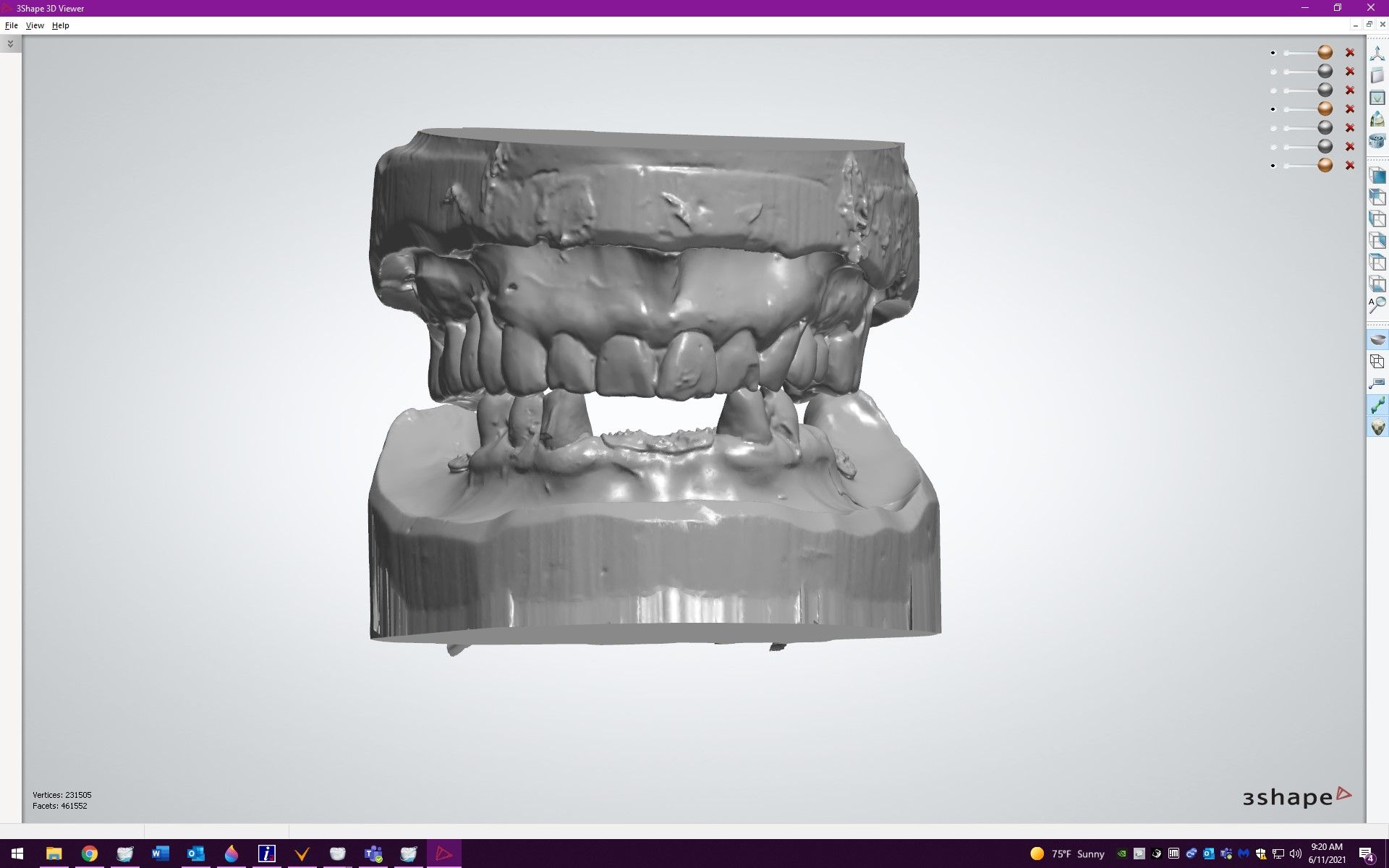 Figure 13. Digital view of digitally mounted virtual casts.