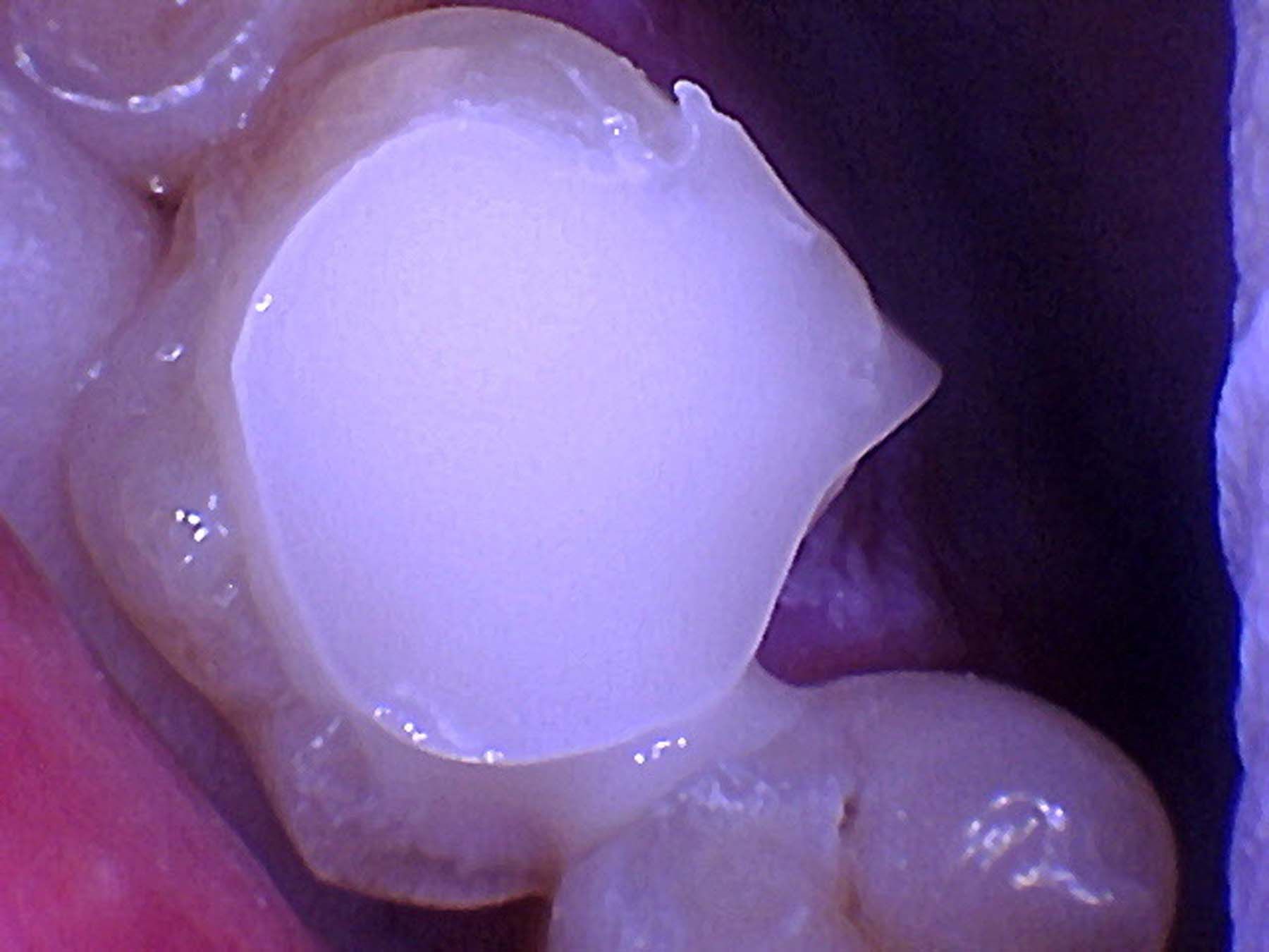 Figure 7.  Without placing a band, I simply used the SDI Stela Primer, air dried, and delivered a large bulk fill of SDI Stela Bulk Fill Flowable Self Cure Restorative