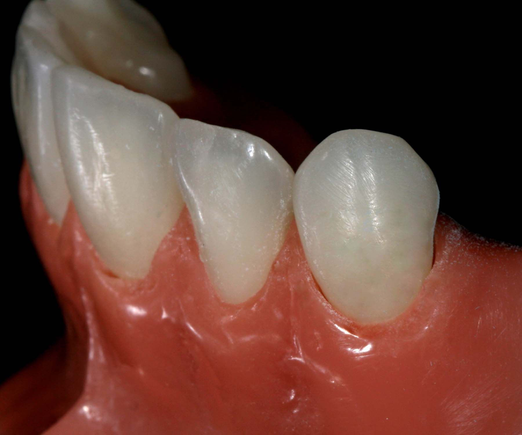 Figure 17. Final polish with OptraGloss