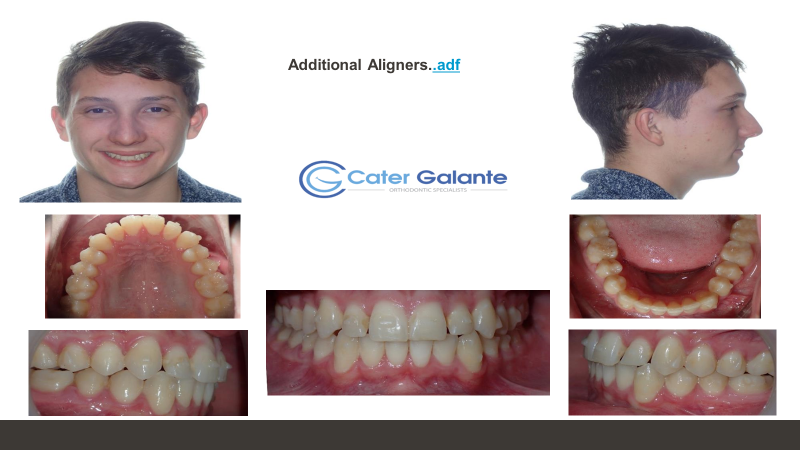 How to enhance the orthodontic experience with Propel VPro