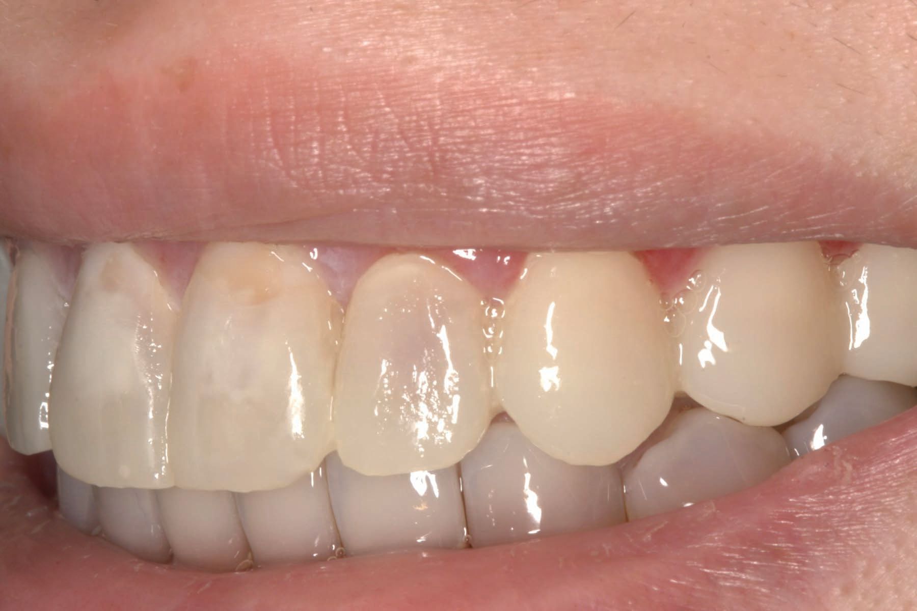 Figure 10. Provisional left lateral smile (note show-through). Clinical photos: Nisha Krishnaiah, DDS