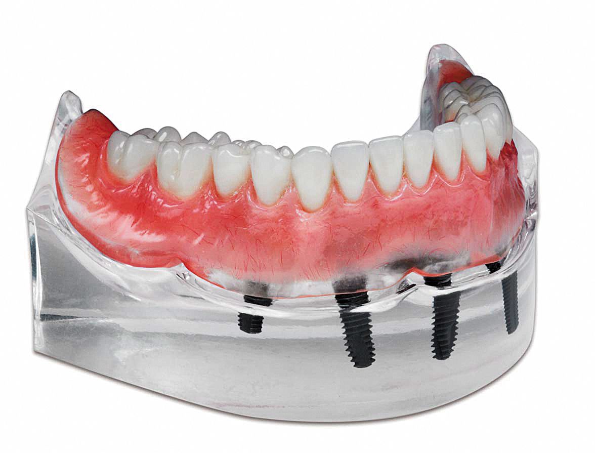 Top Denture Tooth Options.