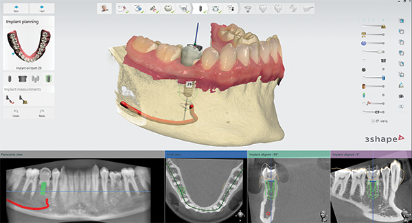 Changing the implant workflow