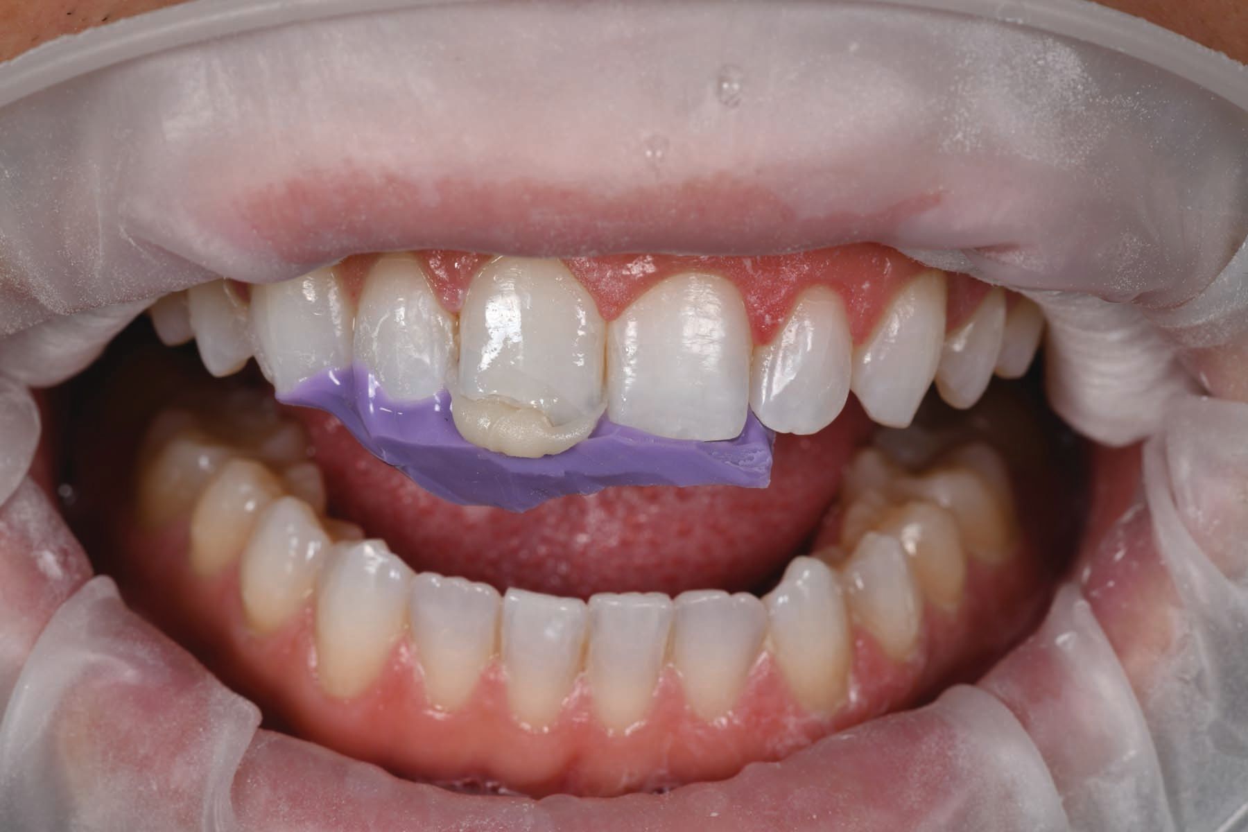 Figures 9 and 10. The silicone matrix was filled with the first layer of composite and was compressed into place to create adaptation while recreating the lingual aspect of the tooth.