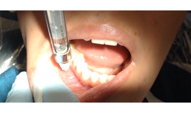 Mandibular Infiltration with Articaine