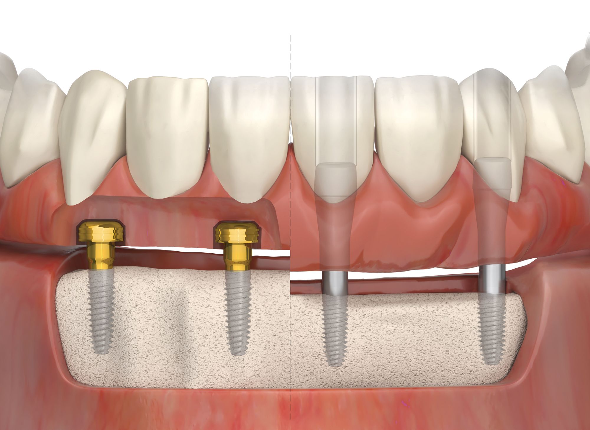 LOCATOR Fixed™ Full Arch Solution
