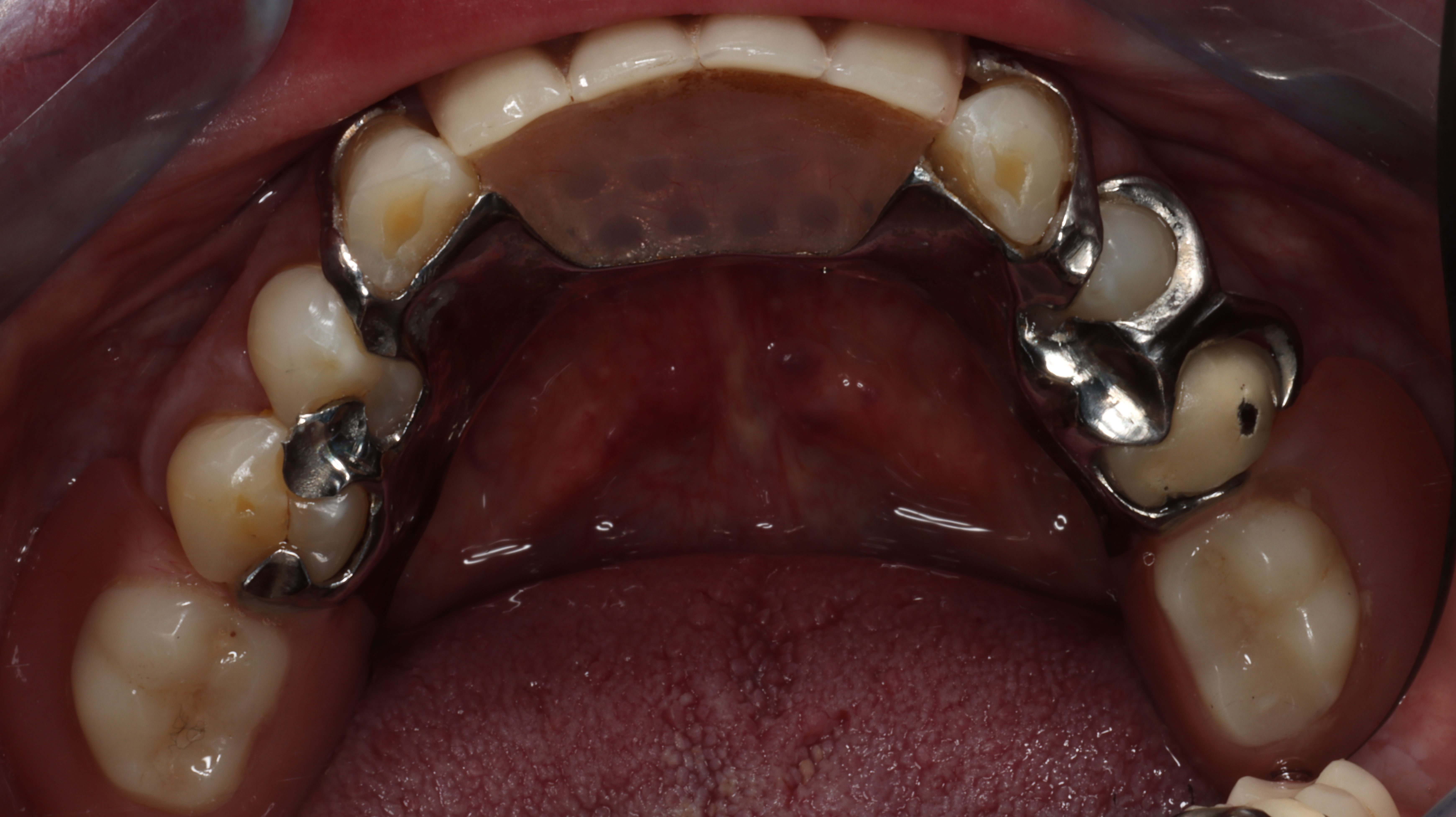 Figure 6. Occlusal view RPD multiple adjustment and fractured clasp mandibular right side.