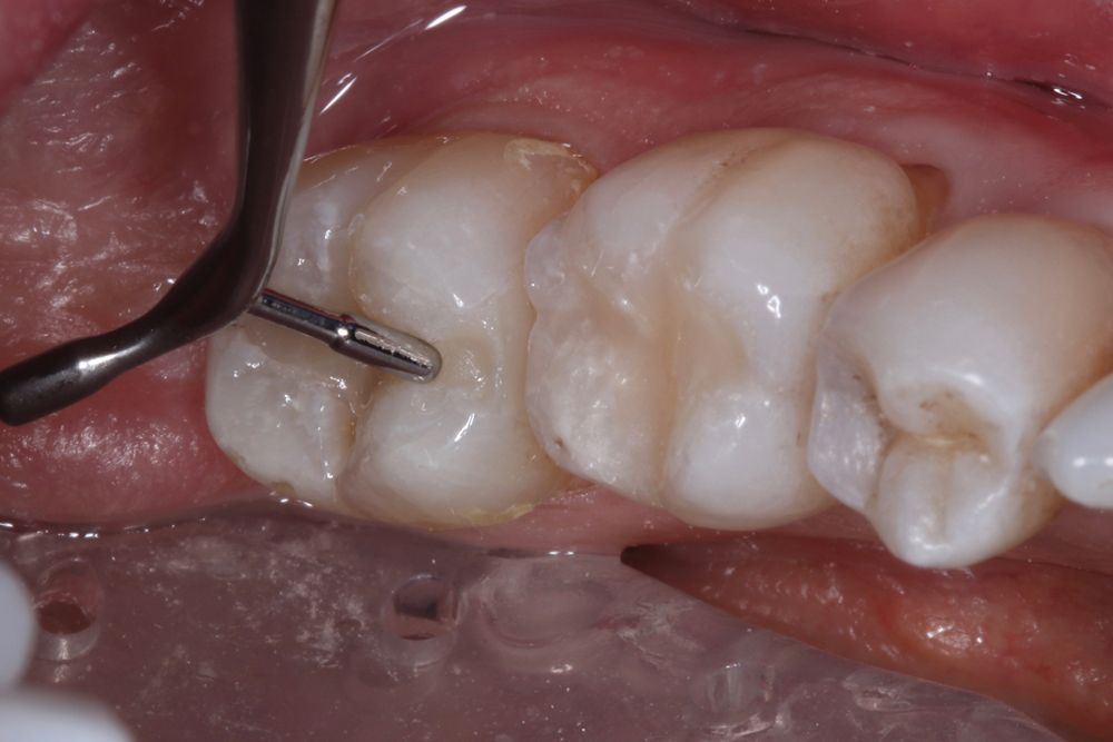 Featured product: CLEARFIL MAJESTY™ ES-2 Universal Composite