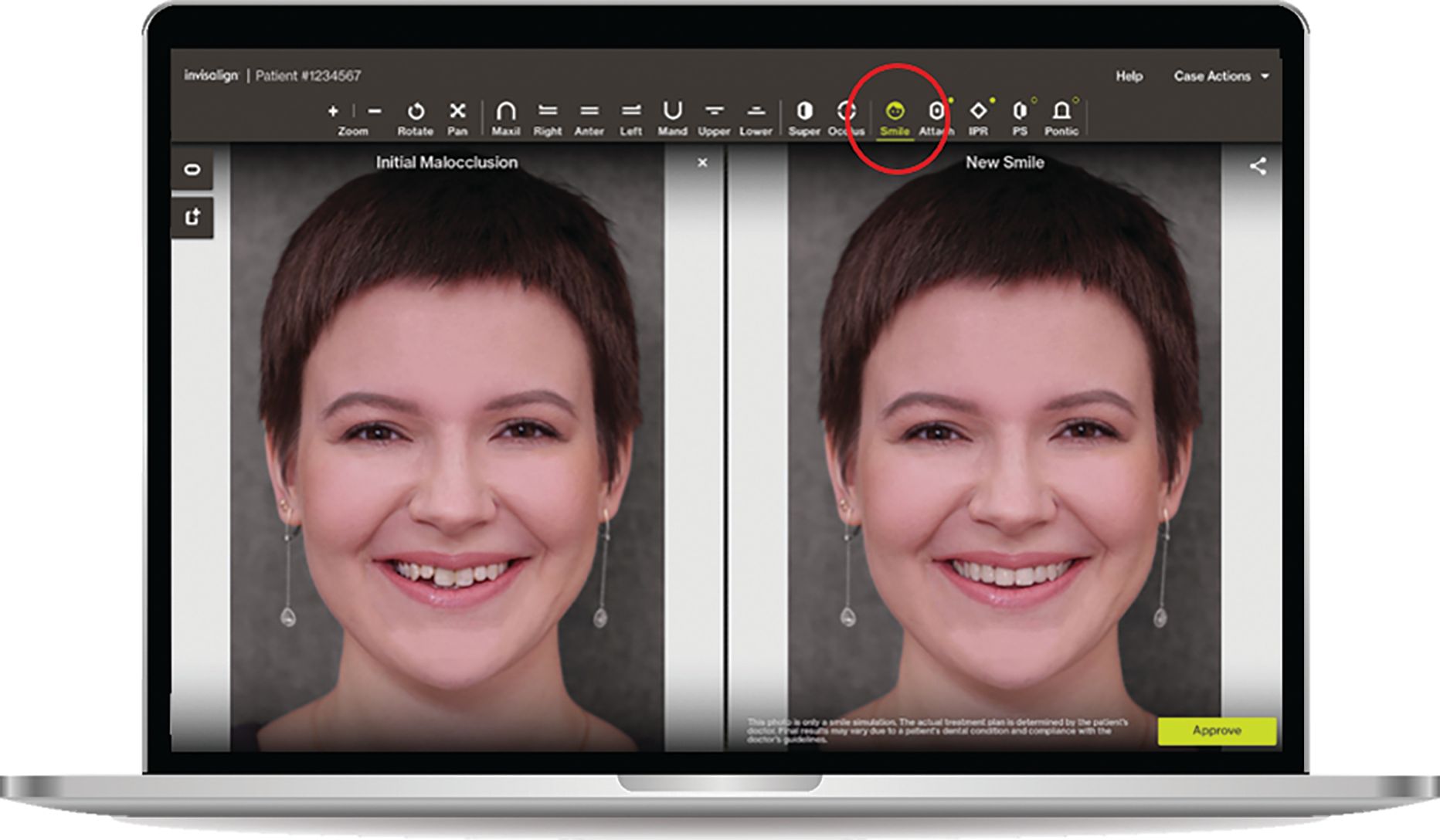 ClinCheck “In-Face” Visualization