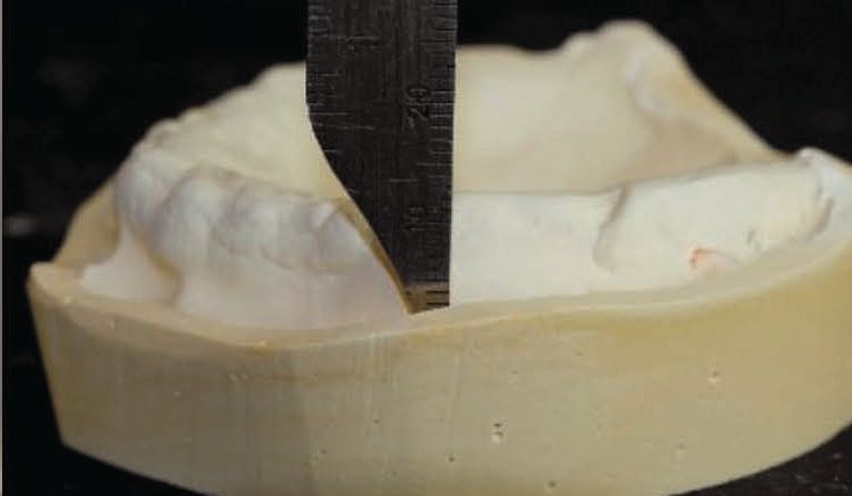 Fig. O The uniform sulcus depth of 2 to 3 mm.