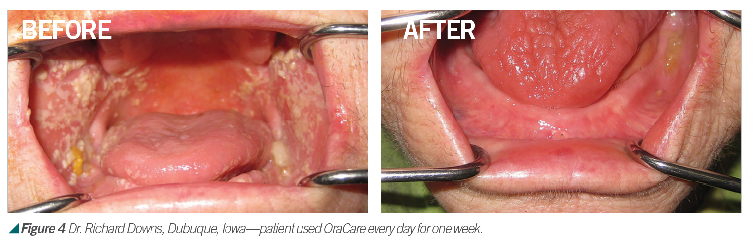 We May Be Headed Toward A New Mouthrinse Protocol We May Be Headed Toward A New Mouthrinse Protocol