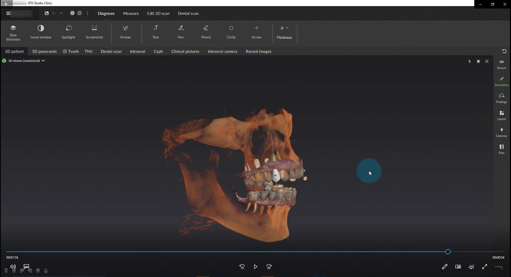 Figure 3 Combining patient data from multiple sources including integrating CBCT volumes and intraoral scan data provides a more comprehensive digital model of the patient. 