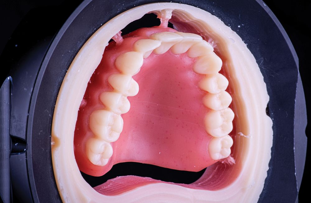 Conrad Fig.3 Reductive denture fabrication