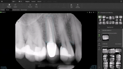 DEXIS Announces Clearance of Artificial Intelligence Findings on 2D Radiographs