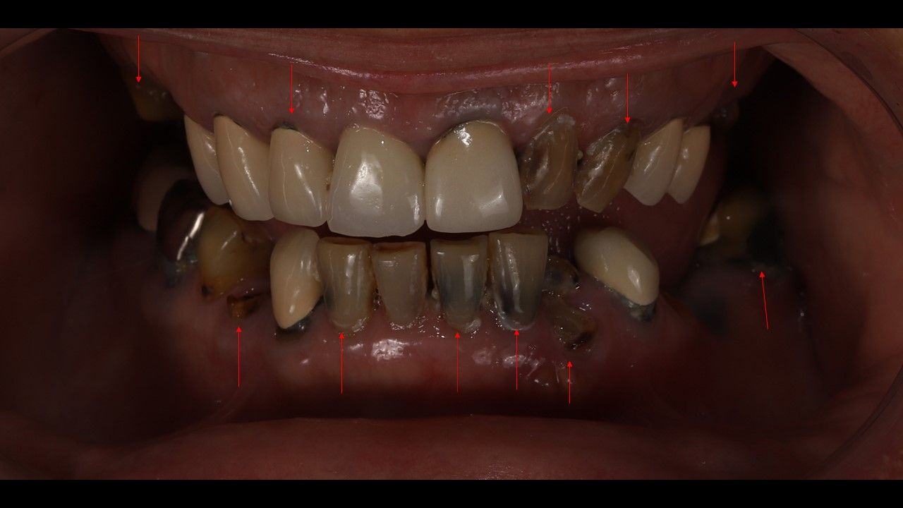 Retracted views of the patient’s oral condition