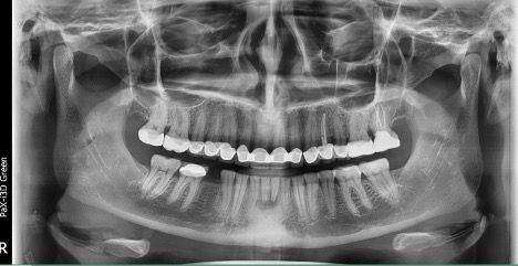 The panoramic x-ray after completing the upper restoration. | Ankur Gupta, DDS