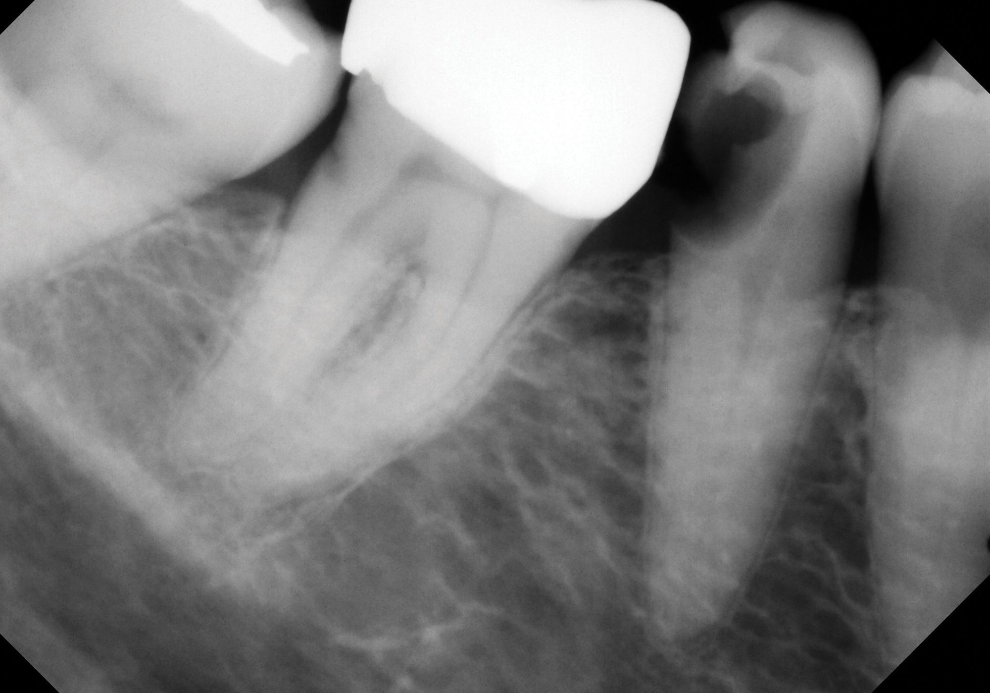 Vital Pulp Therapy in Mature Permanent Teeth: A Paradigm Shift