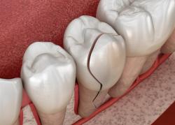 Signs That a Tooth Just Can’t Be Saved