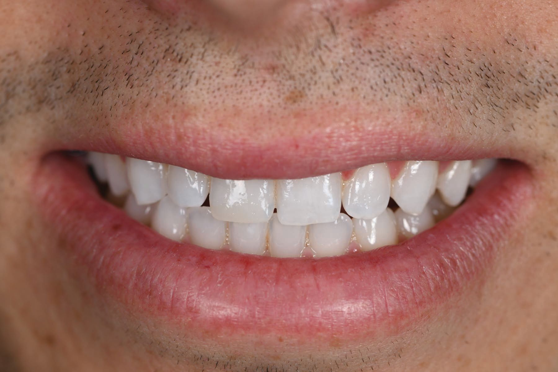 Figure 18. The highly esthetic outcome blended nicely with adjacent dentition.