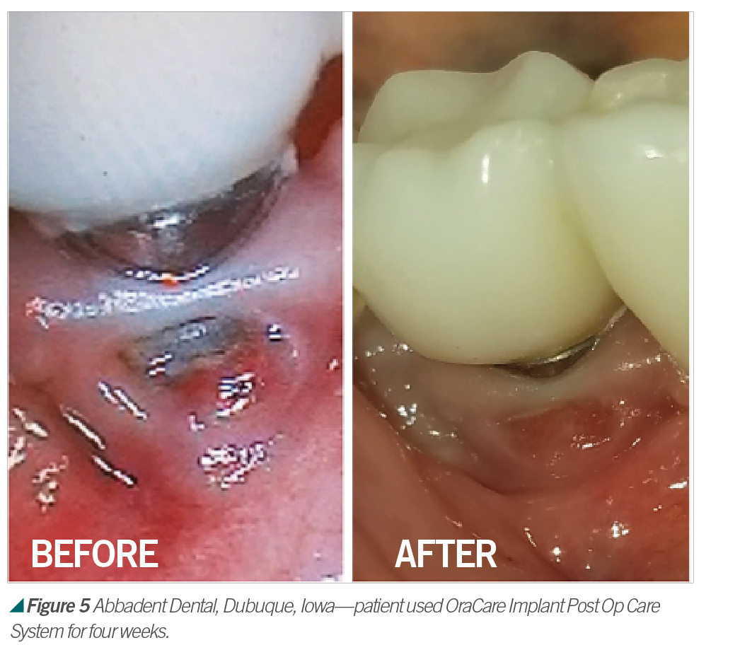 We May Be Headed Toward A New Mouthrinse Protocol We May Be Headed Toward A New Mouthrinse Protocol
