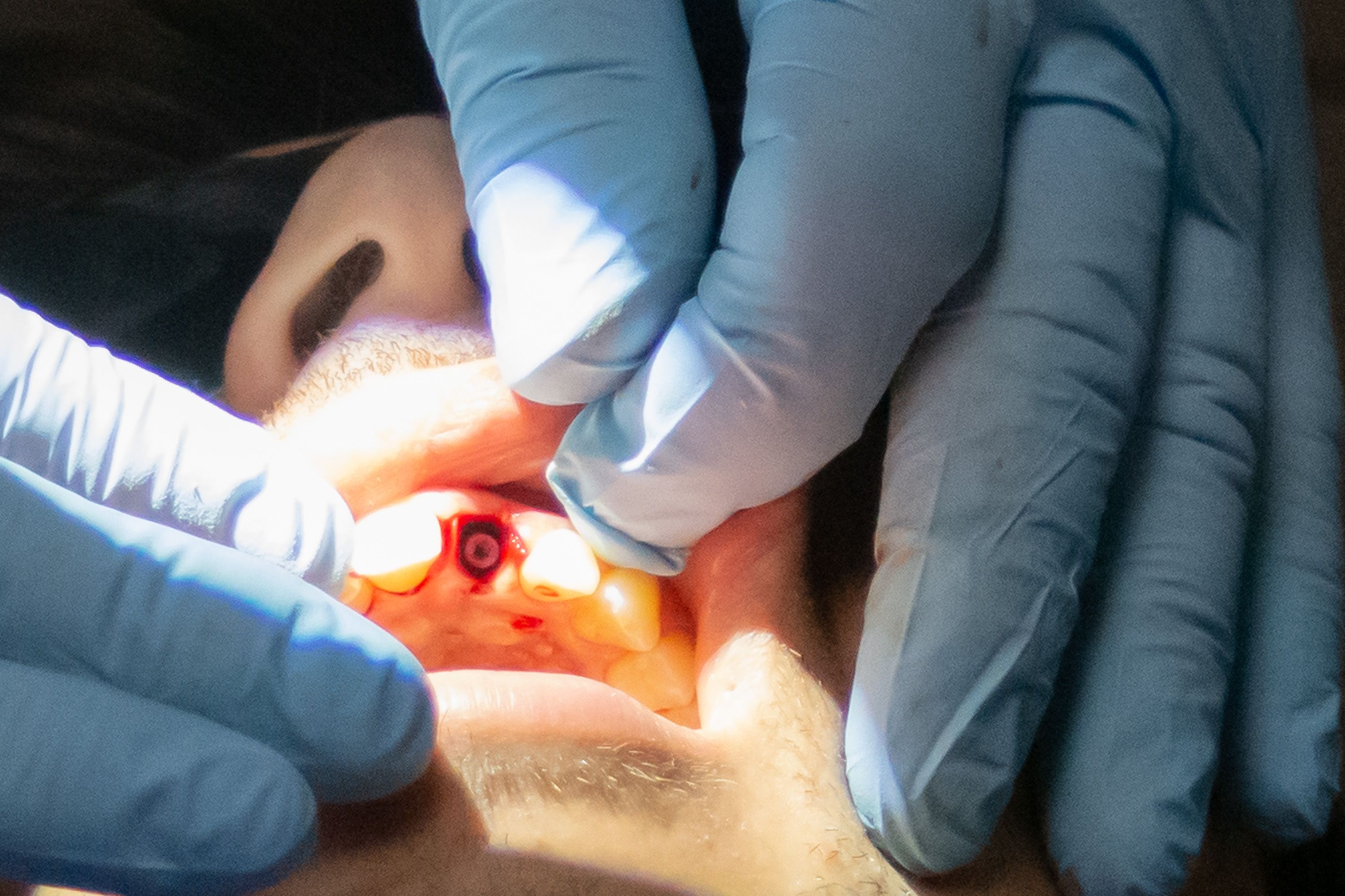 Final placement of dental implant