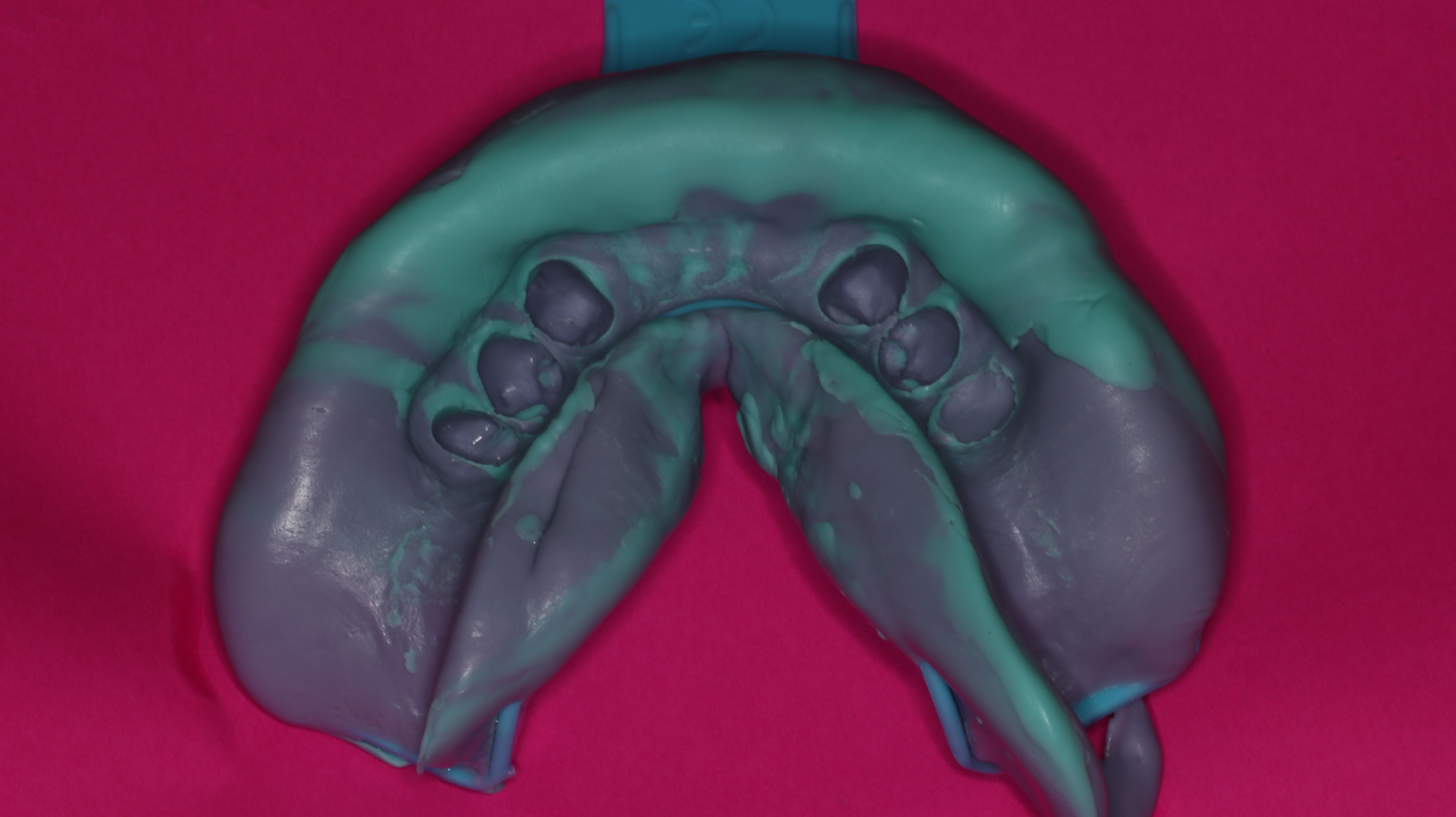 Figure 11. Analog poly-vinyl impression to begin digital workflow fabrication for locator snap-on overdenture (Zest Dental Solutions, ROE Dental Laboratory).