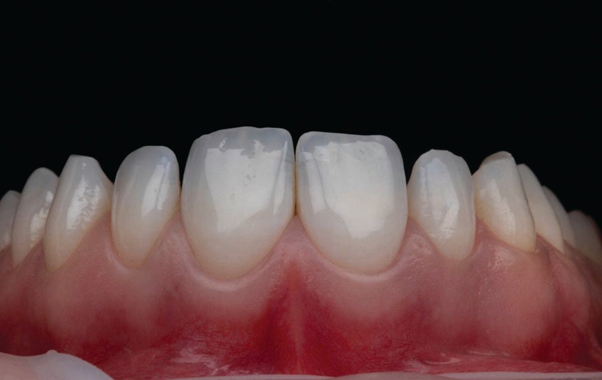 Figures 1 and 2. Before-and-after photos of patient treated with SmileFast. | Image Credit: © SmileFast