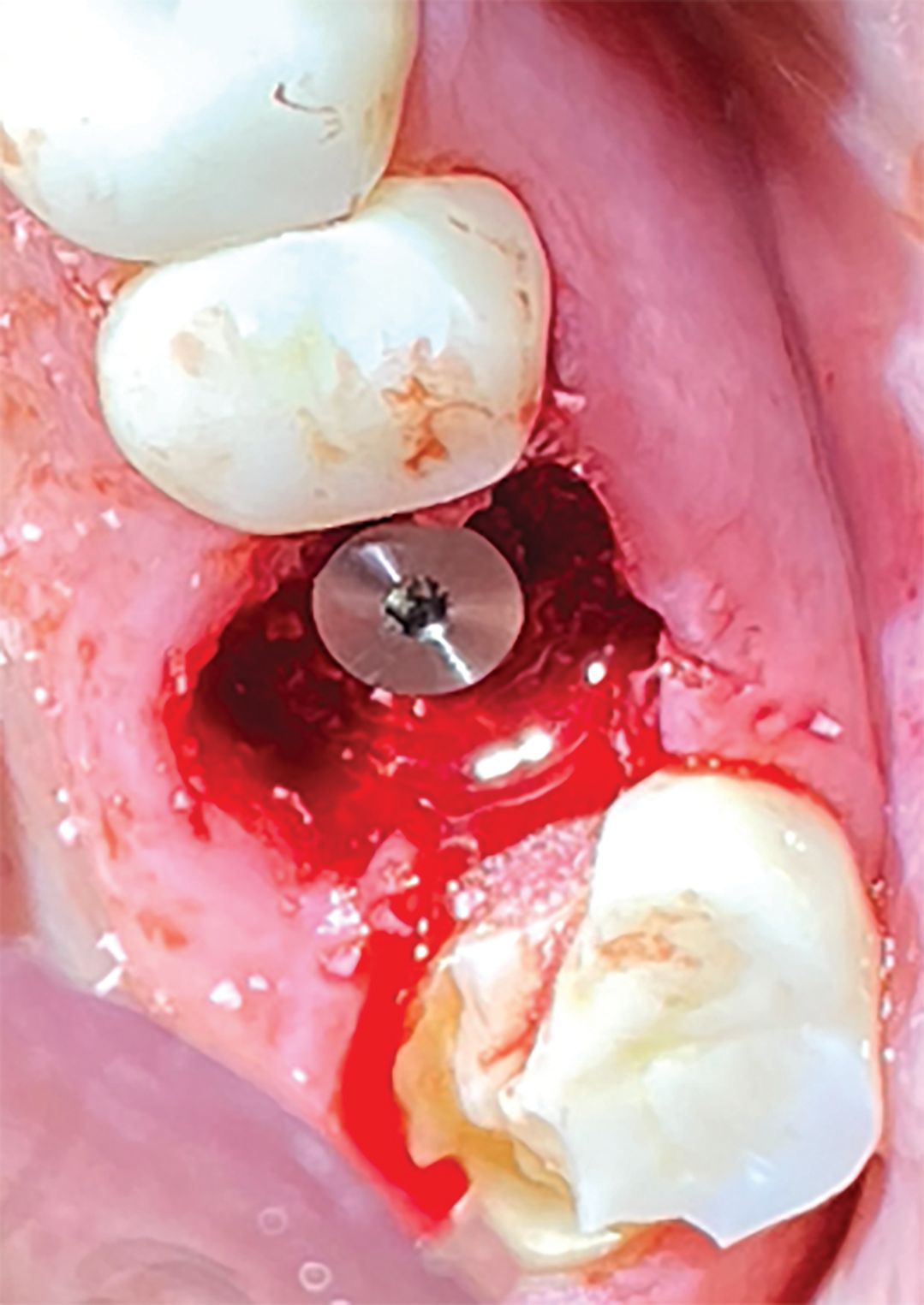 Gingival Cuff Link System