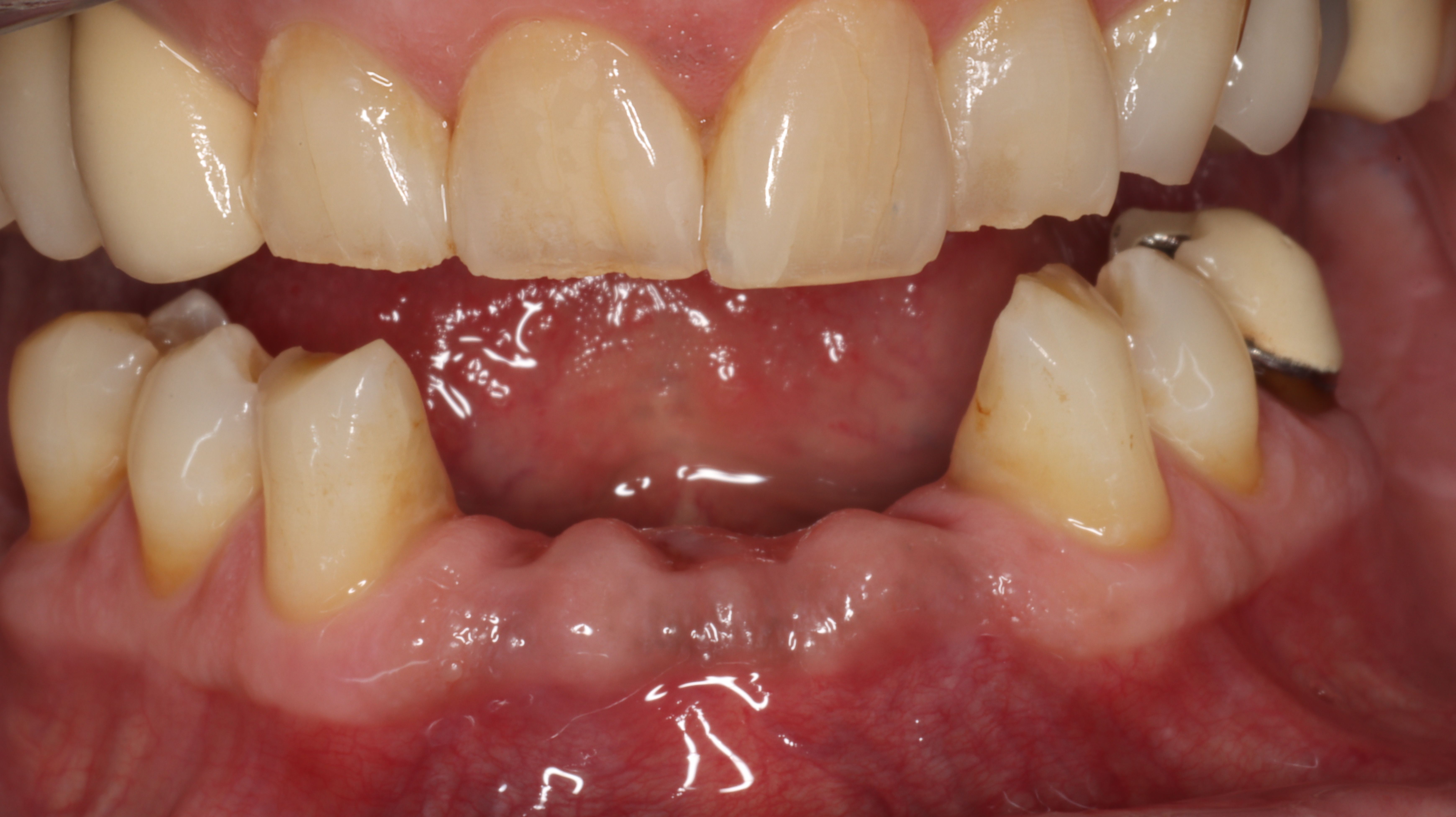 Figure 3. Four weeks post-extractions of mandibular incisors. Begin RPD fabrication