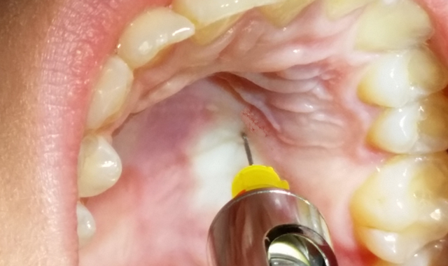 Dental palatal injection