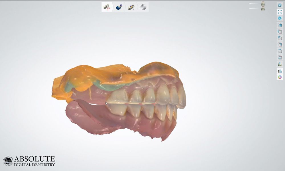 Conrad Fig.6 IO scan of existing denture for prototyping
