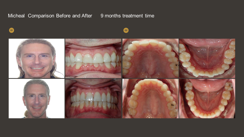 How to enhance the orthodontic experience with Propel VPro