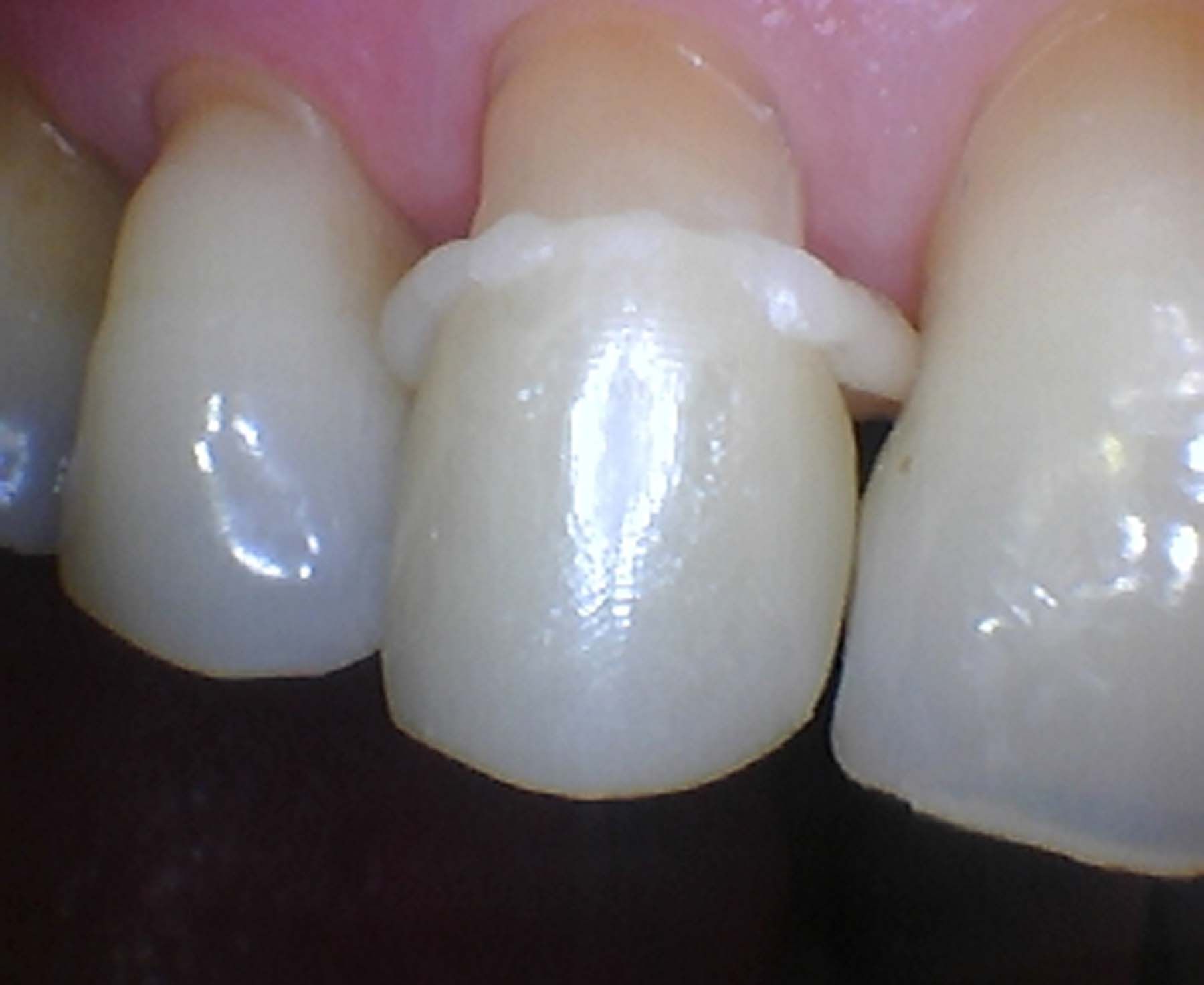 Figures 2 and 3. The crown was filled with Riva Cem Automix , placed onto the prep, and light cured in place. |  Image Credit: © Ben Alvarez, DDS