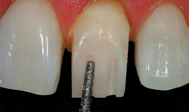 How to perform rapid tooth reduction with diamond instruments