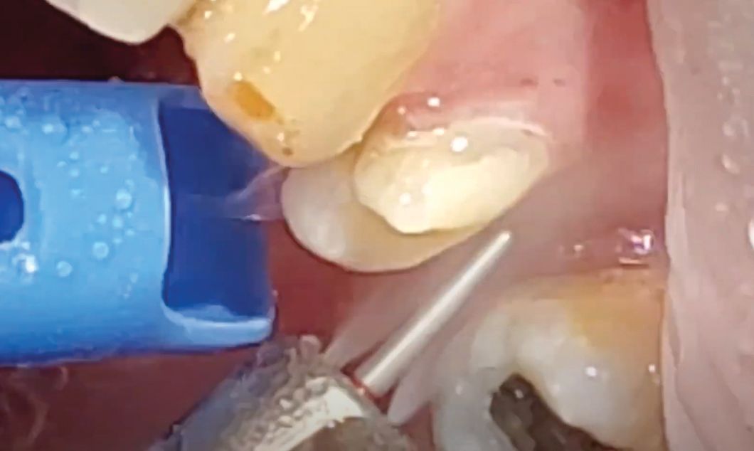 The everX Flow material cuts like natural tooth structure.
