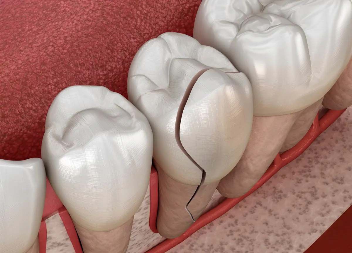 Signs a Tooth Just Can’t be Saved. Image credit: © Alex Mit - stock.adobe.com