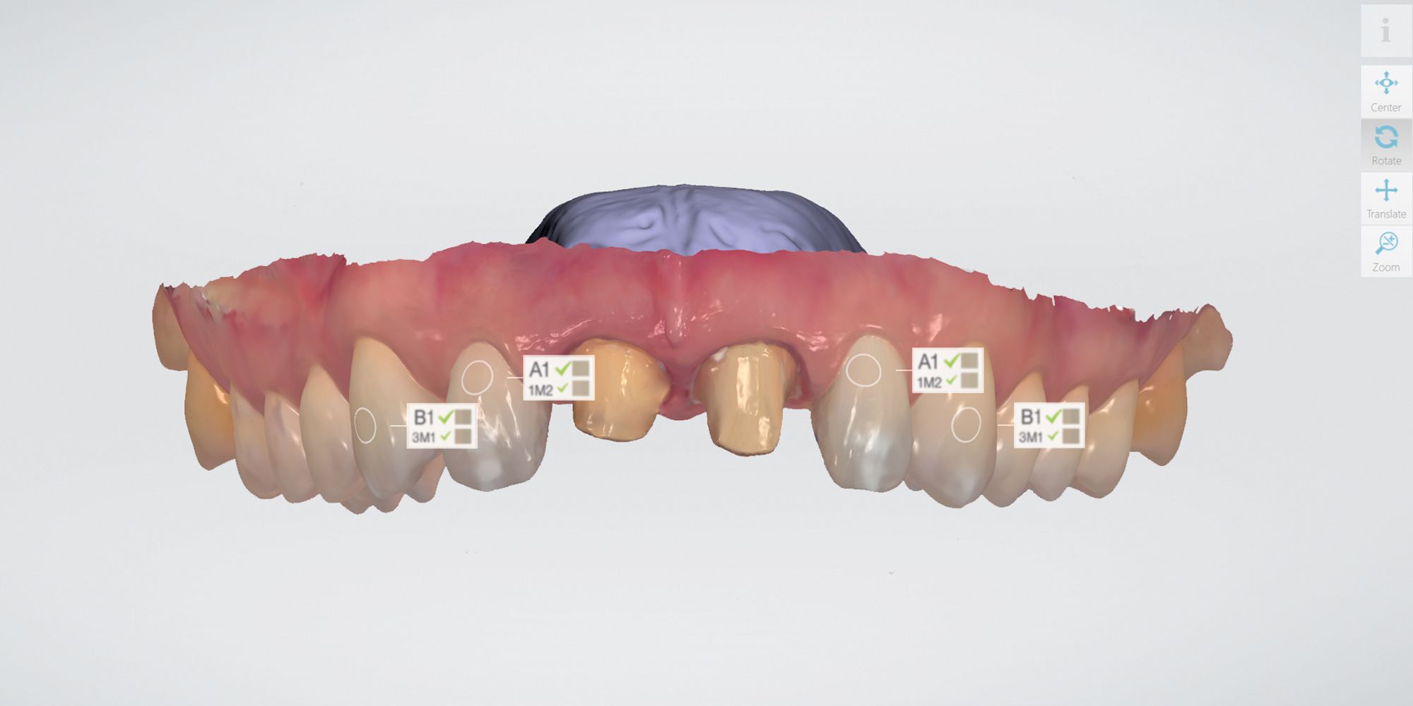 3Shape TRIOS shade matching