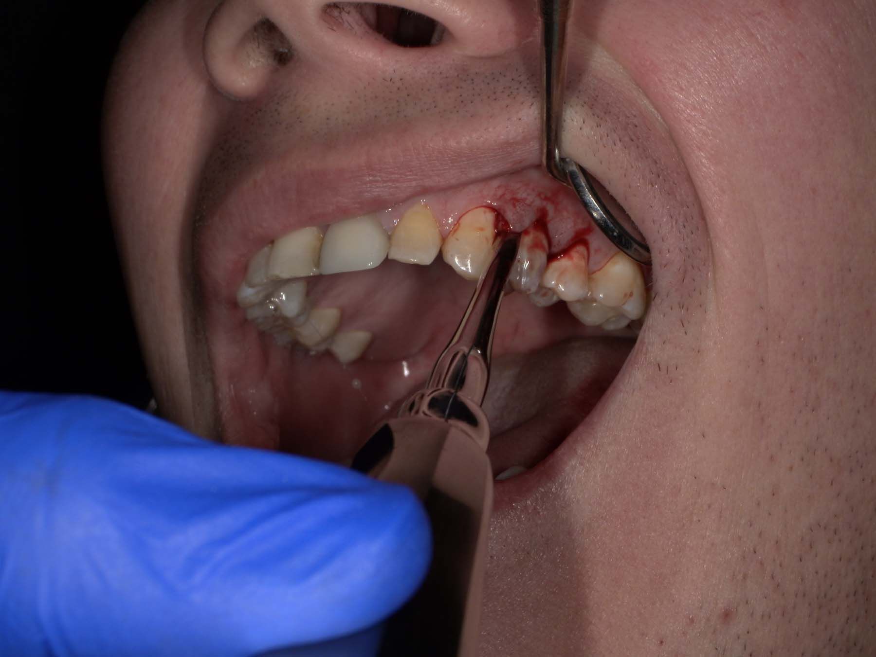 Figure 3. The site is anesthetized with 3 carpules of Septocaine (Septodont USA).