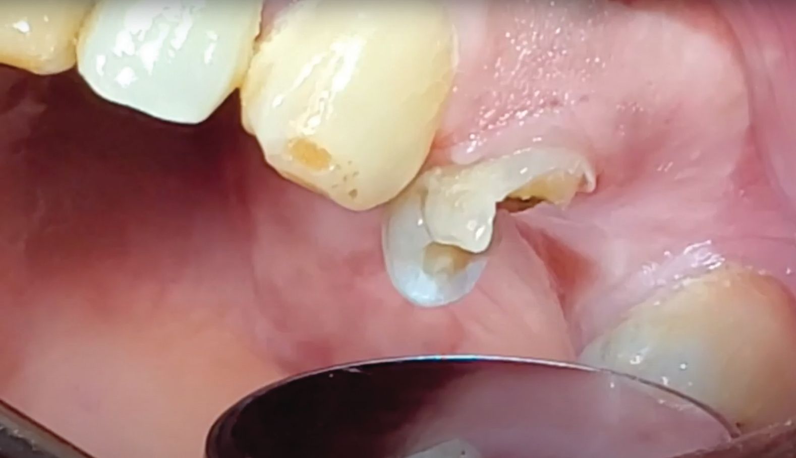 A fractured tooth with the damaged amalgam restoration removed.