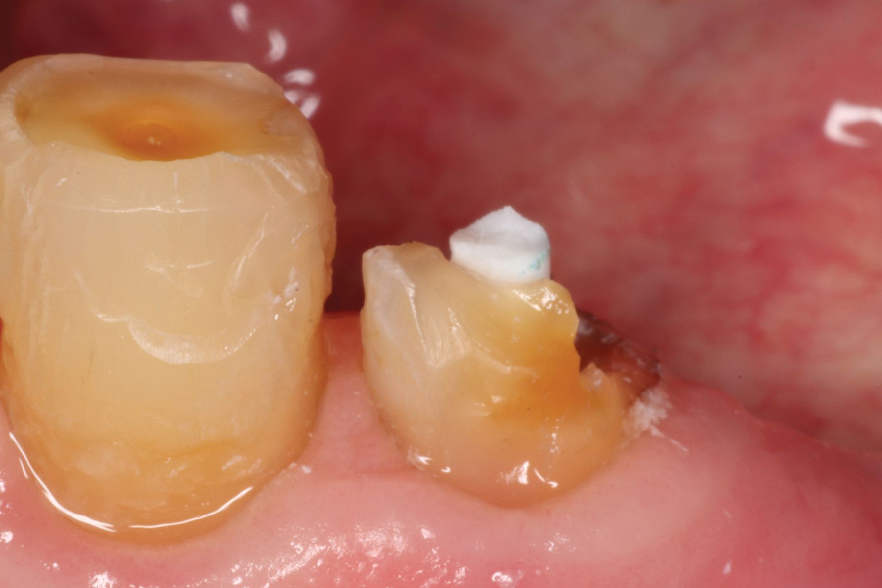 Splendor-SAP From Angelus Dental: Unique and Versatile Post System